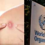 NEW DELHI: WHO decides to declare monkeypox as a global menace