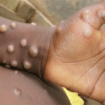 1,363 monkeypox cases confirmed in Canada