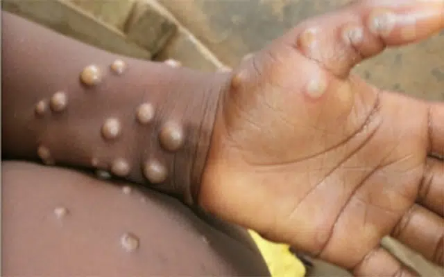 Another monkeypox virus is gearing up to spread to humans
