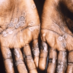 Centre issues guidelines for prevention of monkeypox